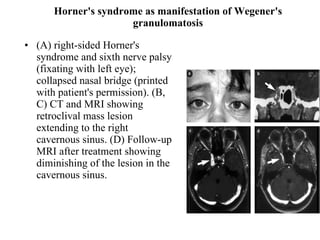 Horner's syndrome as manifestation of Wegener's granulomatosis (A) right-sided Horner's syndrome and sixth nerve palsy (fixating with left eye); collapsed nasal bridge (printed with patient's permission). (B, C) CT and MRI showing retroclival mass lesion extending to the right cavernous sinus. (D) Follow-up MRI after treatment showing diminishing of the lesion in the cavernous sinus.  