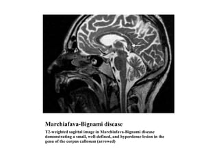 Marchiafava-Bignami disease ,[object Object]