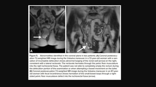 Mri Poop MR Defecating Proctography: Imaging Posterior Pelvic Floor Disorders | PPTX