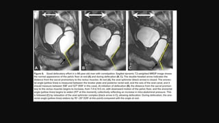 Defecating Proctogram Radiology MR Defecating Proctography: Imaging Posterior Pelvic Floor Disorders | PPTX