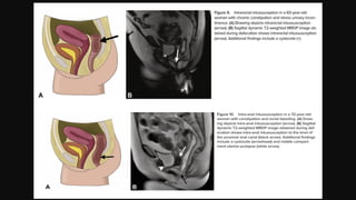 Defecating Proctogram Radiology MR Defecating Proctography: Imaging Posterior Pelvic Floor Disorders | PPTX