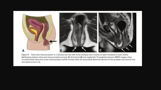 Mri Poop MR Defecating Proctography: Imaging Posterior Pelvic Floor Disorders | PPTX