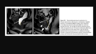 MR Defecating Proctography: Imaging Posterior Pelvic Floor Disorders | PPTX