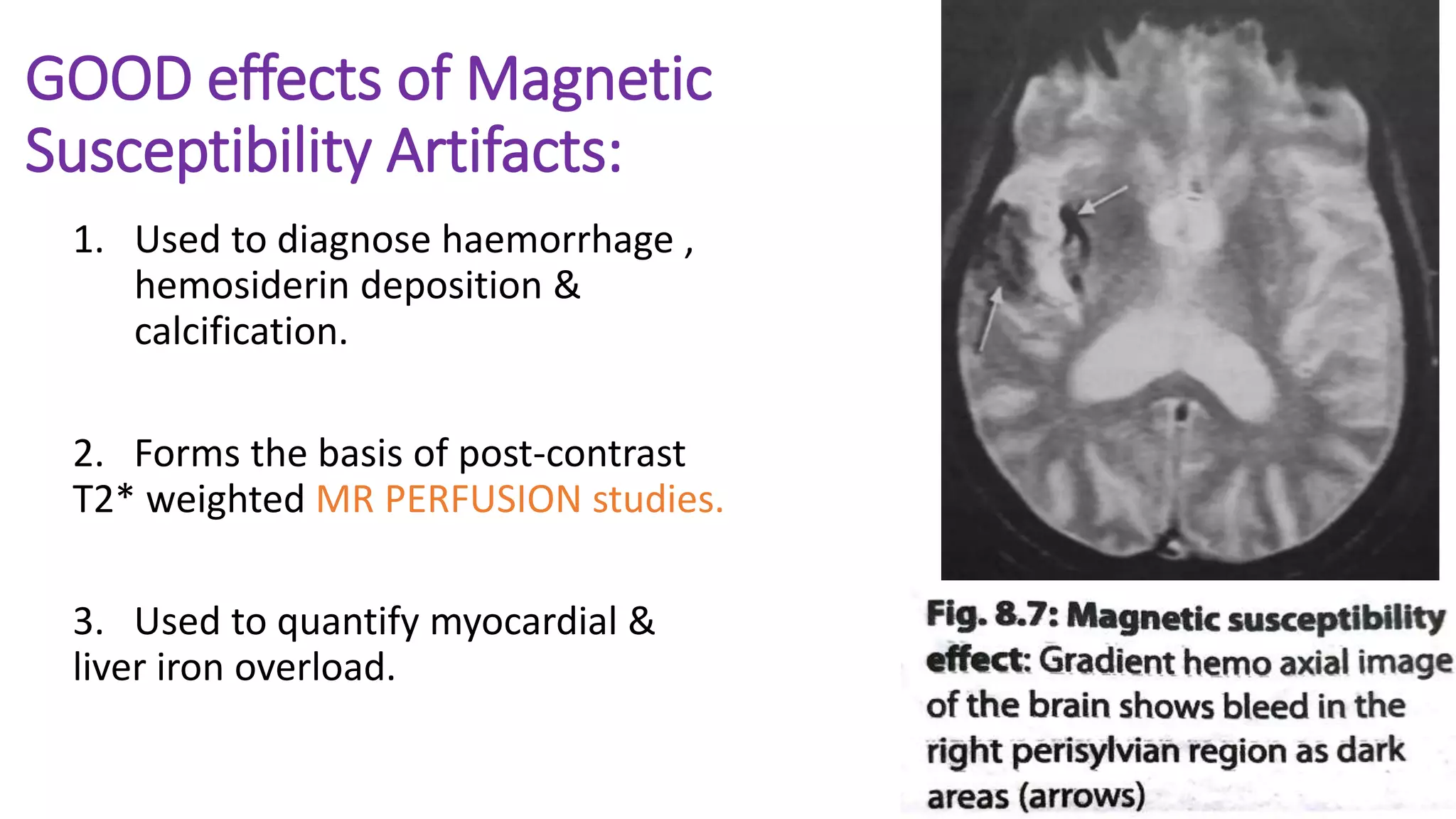 GOOD effects of Magnetic
Susceptibility Artifacts:
1. Used to diagnose haemorrhage ,
hemosiderin deposition &
calcification.
2. Forms the basis of post-contrast
T2* weighted MR PERFUSION studies.
3. Used to quantify myocardial &
liver iron overload.
 