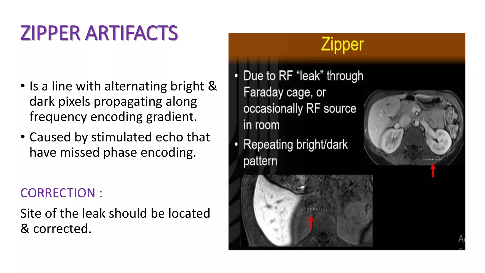 ZIPPER ARTIFACTS
• Is a line with alternating bright &
dark pixels propagating along
frequency encoding gradient.
• Caused by stimulated echo that
have missed phase encoding.
CORRECTION :
Site of the leak should be located
& corrected.
 