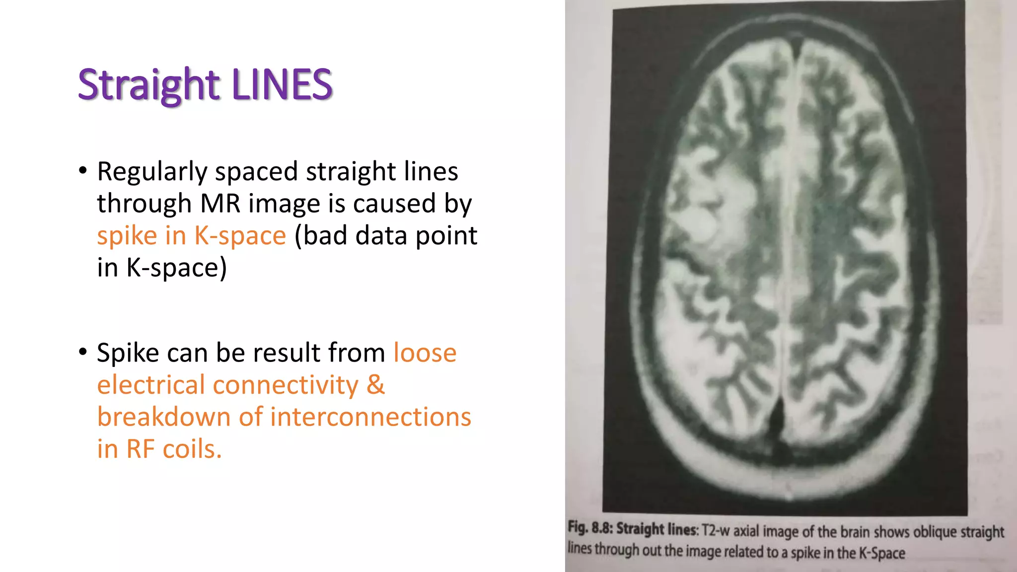 Straight LINES
• Regularly spaced straight lines
through MR image is caused by
spike in K-space (bad data point
in K-space)
• Spike can be result from loose
electrical connectivity &
breakdown of interconnections
in RF coils.
 