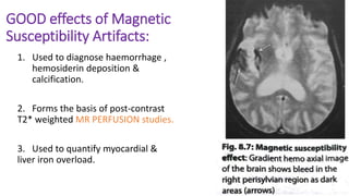 GOOD effects of Magnetic
Susceptibility Artifacts:
1. Used to diagnose haemorrhage ,
hemosiderin deposition &
calcification.
2. Forms the basis of post-contrast
T2* weighted MR PERFUSION studies.
3. Used to quantify myocardial &
liver iron overload.
 