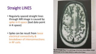 Straight LINES
• Regularly spaced straight lines
through MR image is caused by
spike in K-space (bad data point
in K-space)
• Spike can be result from loose
electrical connectivity &
breakdown of interconnections
in RF coils.
 