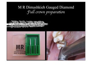 M R Dimashkieh Gauged Diamond
Full crown preparation 
 