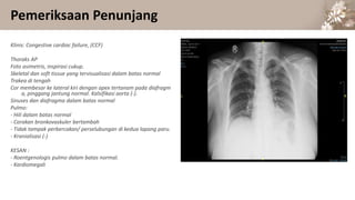 Pemeriksaan Penunjang
Klinis: Congestive cardiac failure, (CCF)
Thoraks AP
Foto asimetris, inspirasi cukup.
Skeletal dan soft tissue yang tervisualisasi dalam batas normal
Trakea di tengah
Cor membesar ke lateral kiri dengan apex tertanam pada diafragm
a, pinggang jantung normal. Kalsifikasi aorta (-).
Sinuses dan diafragma dalam batas normal
Pulmo:
- Hili dalam batas normal
- Corakan bronkovaskuler bertambah
- Tidak tampak perbercakan/ perselubungan di kedua lapang paru.
- Kranialisasi (-)
KESAN :
- Roentgenologis pulmo dalam batas normal.
- Kardiomegali
 