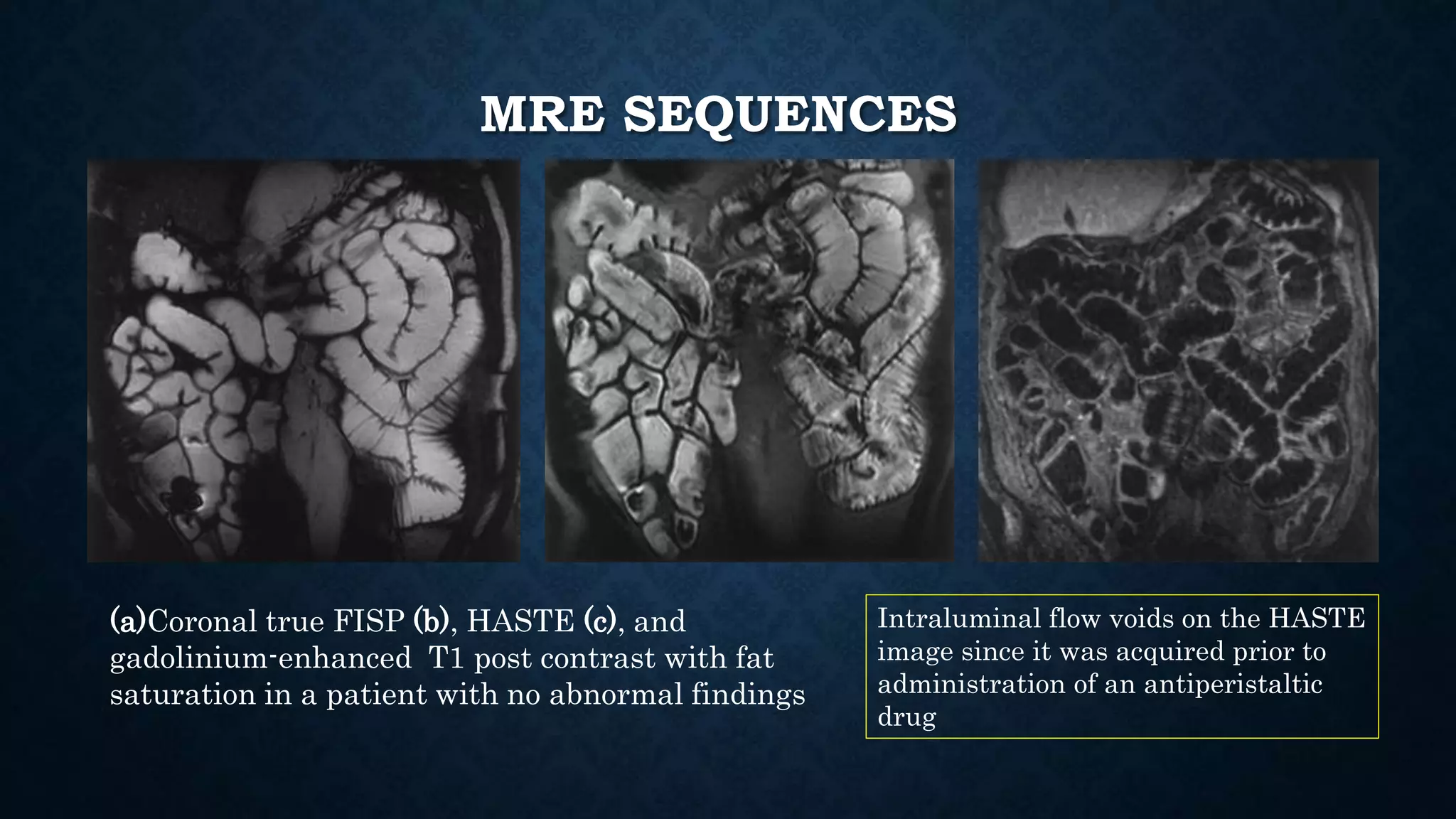 MRE SEQUENCES
(a)Coronal true FISP (b), HASTE (c), and
gadolinium-enhanced T1 post contrast with fat
saturation in a patient with no abnormal findings
Intraluminal flow voids on the HASTE
image since it was acquired prior to
administration of an antiperistaltic
drug
 