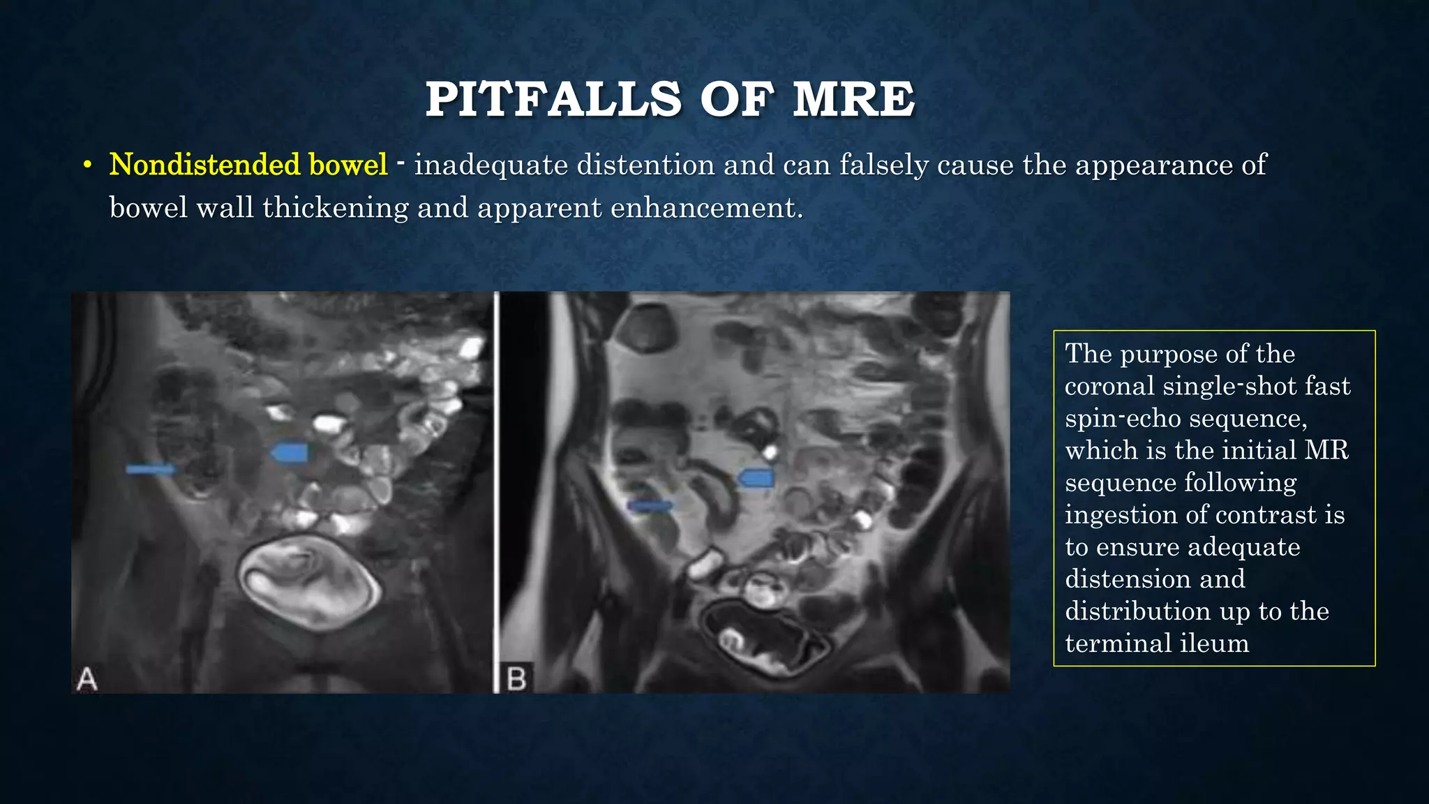 PITFALLS OF MRE
• Nondistended bowel - inadequate distention and can falsely cause the appearance of
bowel wall thickening and apparent enhancement.
The purpose of the
coronal single-shot fast
spin-echo sequence,
which is the initial MR
sequence following
ingestion of contrast is
to ensure adequate
distension and
distribution up to the
terminal ileum
 