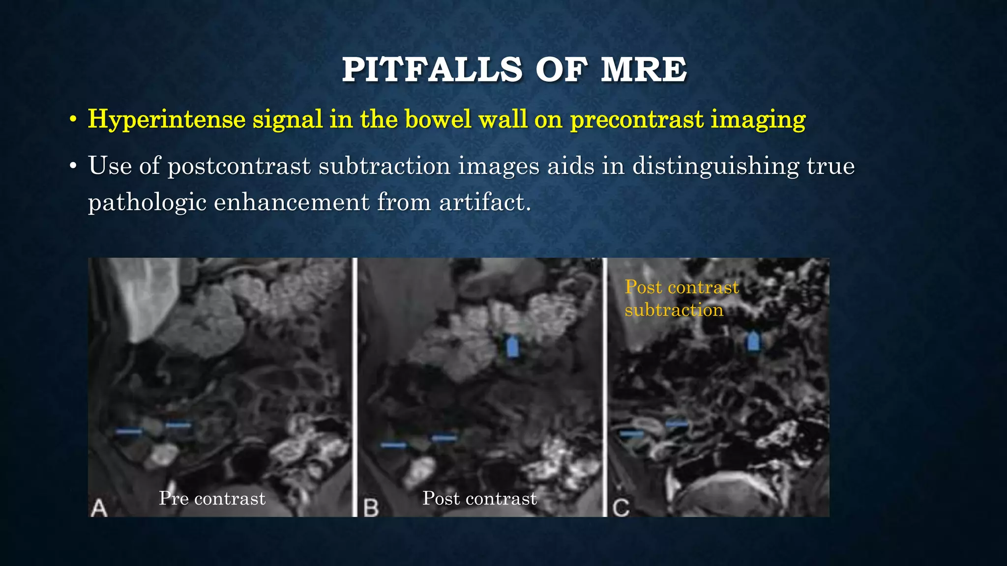 PITFALLS OF MRE
• Hyperintense signal in the bowel wall on precontrast imaging
• Use of postcontrast subtraction images aids in distinguishing true
pathologic enhancement from artifact.
Pre contrast Post contrast
Post contrast
subtraction
 