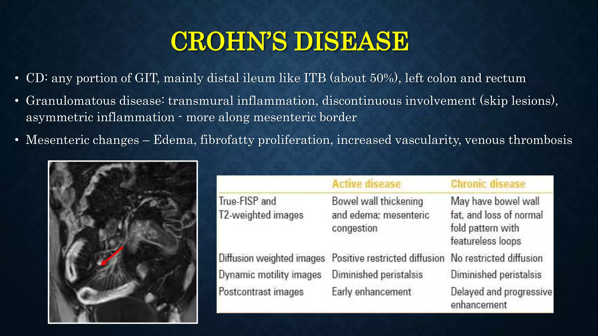 CROHN’S DISEASE
• CD: any portion of GIT, mainly distal ileum like ITB (about 50%), left colon and rectum
• Granulomatous disease: transmural inflammation, discontinuous involvement (skip lesions),
asymmetric inflammation - more along mesenteric border
• Mesenteric changes – Edema, fibrofatty proliferation, increased vascularity, venous thrombosis
 