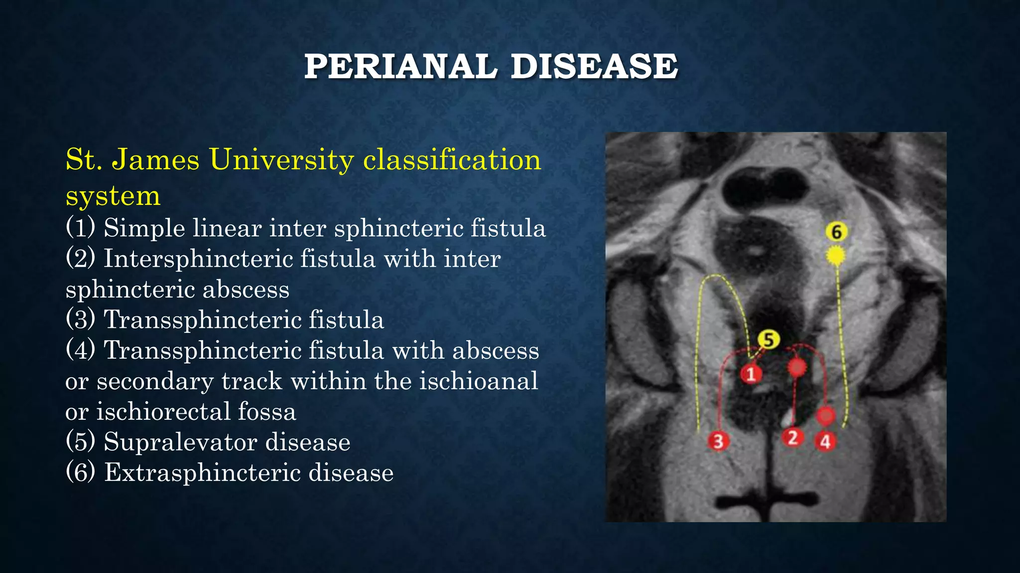 PERIANAL DISEASE
St. James University classification
system
(1) Simple linear inter sphincteric fistula
(2) Intersphincteric fistula with inter
sphincteric abscess
(3) Transsphincteric fistula
(4) Transsphincteric fistula with abscess
or secondary track within the ischioanal
or ischiorectal fossa
(5) Supralevator disease
(6) Extrasphincteric disease
 