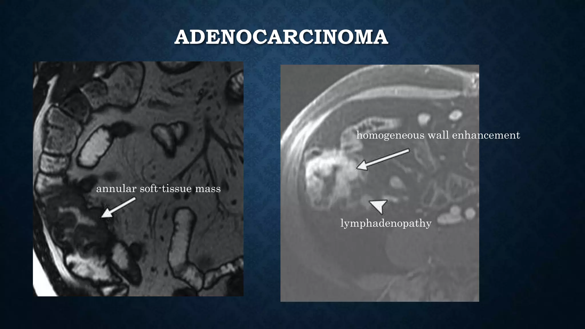 ADENOCARCINOMA
annular soft-tissue mass
homogeneous wall enhancement
lymphadenopathy
 