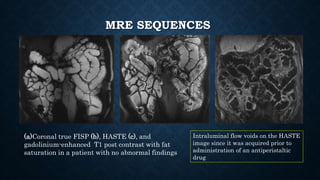MRE SEQUENCES
(a)Coronal true FISP (b), HASTE (c), and
gadolinium-enhanced T1 post contrast with fat
saturation in a patient with no abnormal findings
Intraluminal flow voids on the HASTE
image since it was acquired prior to
administration of an antiperistaltic
drug
 