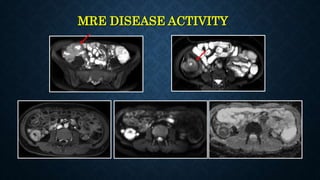 MRE DISEASE ACTIVITY
 