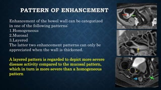 PATTERN OF ENHANCEMENT
Enhancement of the bowel wall can be categorized
in one of the following patterns:
1.Homogeneous
2.Mucosal
3.Layered
The latter two enhancement patterns can only be
appreciated when the wall is thickened.
A layered pattern is regarded to depict more severe
disease activity compared to the mucosal pattern,
which in turn is more severe than a homogeneous
pattern
 