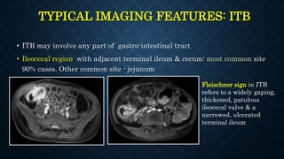 TYPICAL IMAGING FEATURES: ITB
• ITB may involve any part of gastro-intestinal tract
• Ileocecal region with adjacent terminal ileum & cecum: most common site
90% cases. Other common site - jejunum
Fleischner sign in ITB
refers to a widely gaping,
thickened, patulous
ileocecal valve & a
narrowed, ulcerated
terminal ileum
 