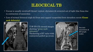 ILEOCECAL TB
• Cecum is usually involved(>ileum): conical, shrunken & retracted out of right iliac fossa due
to contraction of mesocolon
• Loss of normal ileocecal angle & ileum may appear suspended from shrunken cecum (Goose
neck deformity)
T1W FS CE coronal images
showing “goose neck
deformity”
Thickening of IC valve with
contracted pulled up cecum
Necrotic
mesenteric &
RP lymph
nodes
 