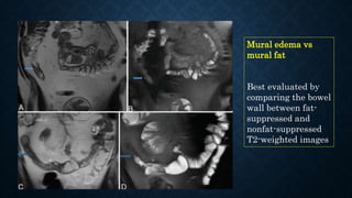 Mural edema vs
mural fat
Best evaluated by
comparing the bowel
wall between fat-
suppressed and
nonfat-suppressed
T2-weighted images
 