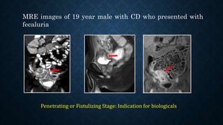 MRE images of 19 year male with CD who presented with
fecaluria
Penetrating or Fistulizing Stage: Indication for biologicals
 