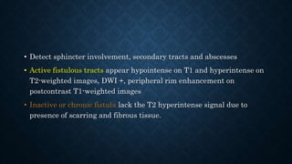 • Detect sphincter involvement, secondary tracts and abscesses
• Active fistulous tracts appear hypointense on T1 and hyperintense on
T2-weighted images, DWI +, peripheral rim enhancement on
postcontrast T1-weighted images
• Inactive or chronic fistula lack the T2 hyperintense signal due to
presence of scarring and fibrous tissue.
 