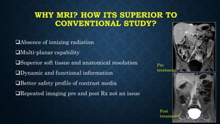 WHY MRI? HOW ITS SUPERIOR TO
CONVENTIONAL STUDY?
Absence of ionizing radiation
Multi-planar capability
Superior soft tissue and anatomical resolution
Dynamic and functional information
Better safety profile of contrast media
Repeated imaging pre and post Rx not an issue
Pre
treatment
Post
treatment
 