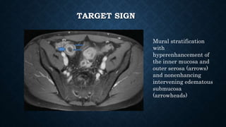 TARGET SIGN
Mural stratification
with
hyperenhancement of
the inner mucosa and
outer serosa (arrows)
and nonenhancing
intervening edematous
submucosa
(arrowheads)
 
