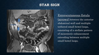 STAR SIGN
Enterocutaneous fistula
(arrows) between the anterior
abdominal wall and multiple
tethered small bowel loops,
consisting of a stellate pattern
of mesenteric enhancement
extending between multiple
small bowel loops.
 