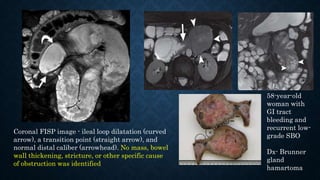 Coronal FISP image - ileal loop dilatation (curved
arrow), a transition point (straight arrow), and
normal distal caliber (arrowhead). No mass, bowel
wall thickening, stricture, or other specific cause
of obstruction was identified
58-year-old
woman with
GI tract
bleeding and
recurrent low-
grade SBO
Dx- Brunner
gland
hamartoma
 