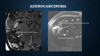 ADENOCARCINOMA
annular soft-tissue mass
homogeneous wall enhancement
lymphadenopathy
 