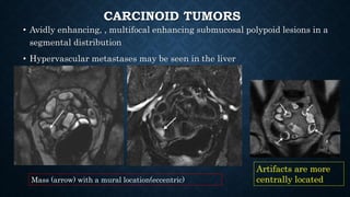 CARCINOID TUMORS
• Avidly enhancing, , multifocal enhancing submucosal polypoid lesions in a
segmental distribution
• Hypervascular metastases may be seen in the liver
Mass (arrow) with a mural location(eccentric)
Artifacts are more
centrally located
 