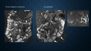 Peutz Jeghers syndrome Lymphoma
 