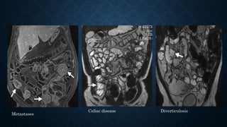 Metastases
Celiac disease Diverticulosis
 