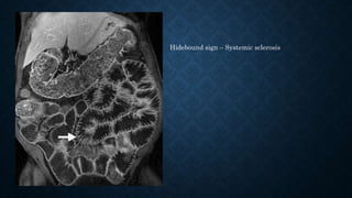 Hidebound sign – Systemic sclerosis
 