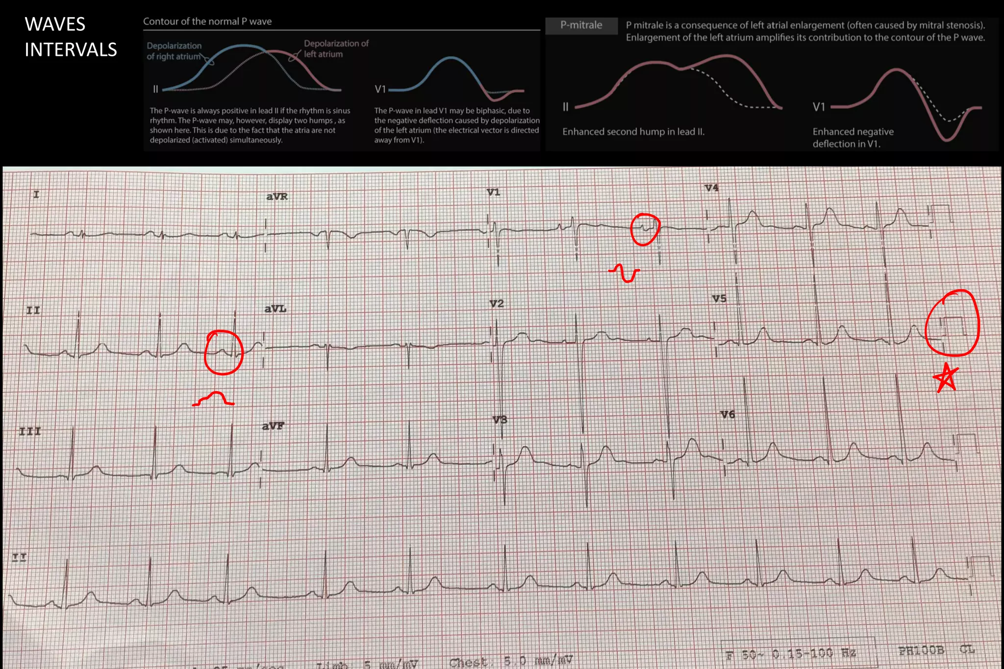 Mitral Regurgitation - ECG , Chest X- Ray | PDF