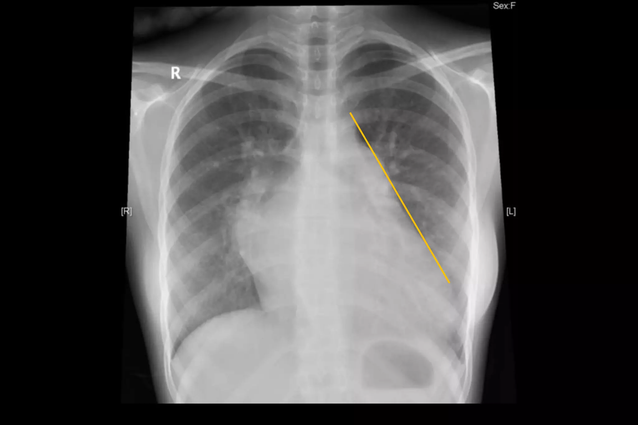 mitral-regurgitation-ecg-chest-xray-ppt-free-download