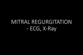 MITRAL REGURGITATION
- ECG, X-Ray
 