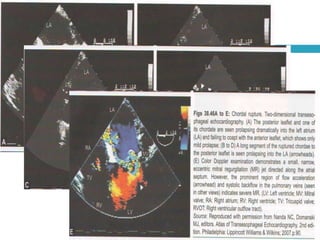 ECHOCARDIOGRAPHIC EVALUATION OF MITRAL VALVE DISEASE -MITRAL ...