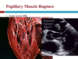 ECHOCARDIOGRAPHIC EVALUATION OF MITRAL VALVE DISEASE -MITRAL ...