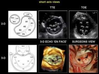 ECHOCARDIOGRAPHIC EVALUATION OF MITRAL VALVE DISEASE -MITRAL ...