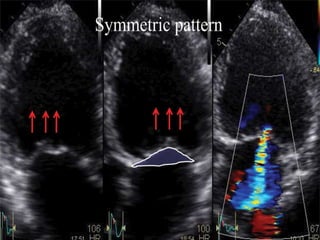 ECHOCARDIOGRAPHIC EVALUATION OF MITRAL VALVE DISEASE -MITRAL ...