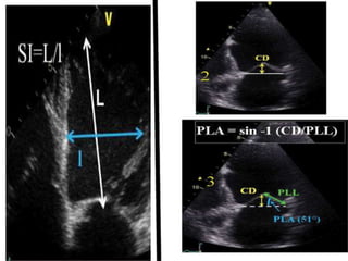 ECHOCARDIOGRAPHIC EVALUATION OF MITRAL VALVE DISEASE -MITRAL ...