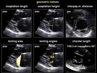 ECHOCARDIOGRAPHIC EVALUATION OF MITRAL VALVE DISEASE -MITRAL ...