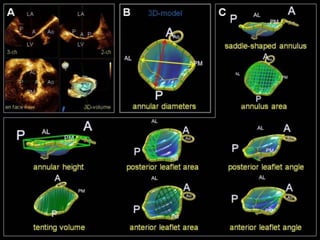 ECHOCARDIOGRAPHIC EVALUATION OF MITRAL VALVE DISEASE -MITRAL ...
