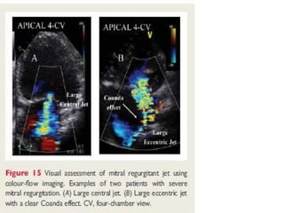 ECHOCARDIOGRAPHIC EVALUATION OF MITRAL VALVE DISEASE -MITRAL ...