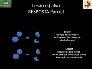 Lesão (s) alvo
RESPOSTA Parcial
RECIST
Redução de pelo menos
30% na soma dos diâmetros
das lesões alvo
mRECIST
Redução de pelo menos
30% no total das lesões alvos viáveis
(marcação na fase arterial)
 