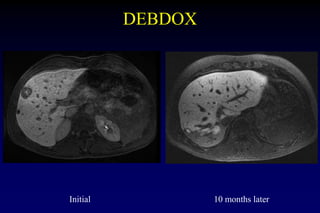 Metastatic Uveal Melanoma Treatment - 2019 CURE OM Symposium | PPTX
